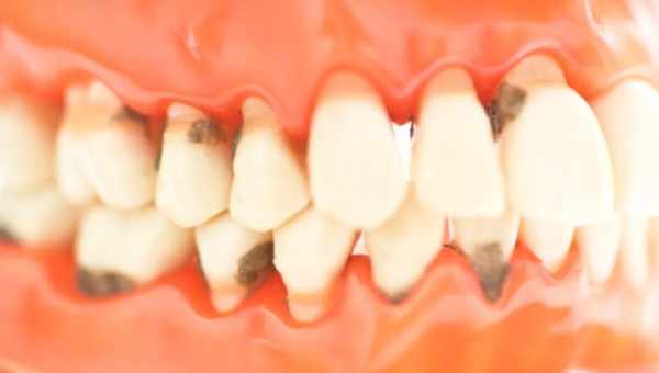 Некроз тканин зуба