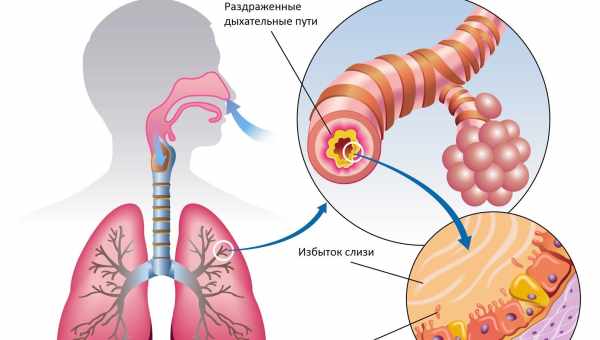 Використання бромгексину при загостреннях хронічного бронхіту