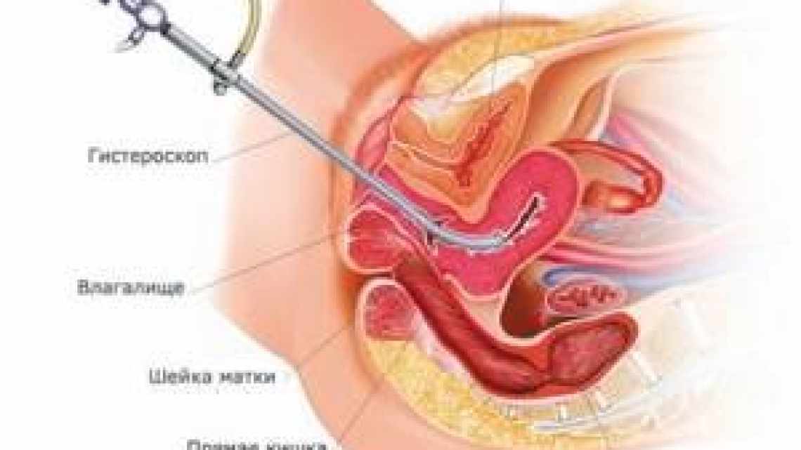 Гістероскопія матки - що це таке?