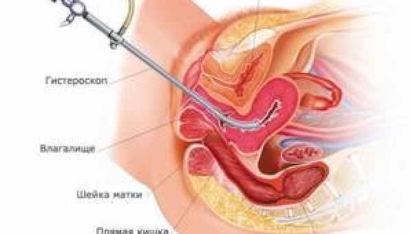 Гістероскопія матки - що це таке?