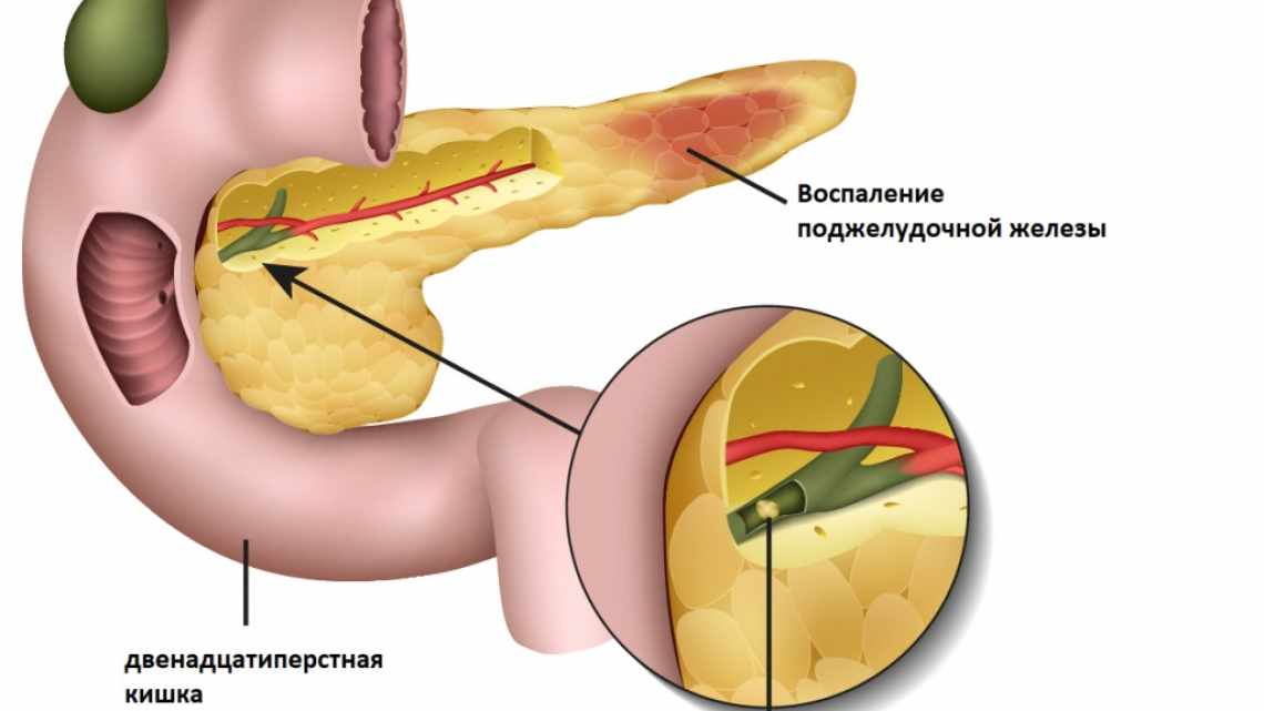 Холецистит: гіркота в роті