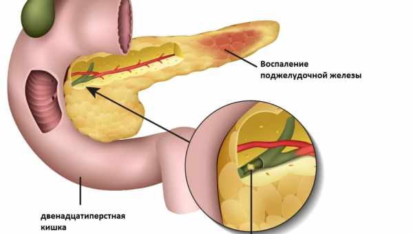 Холецистит: гіркота в роті