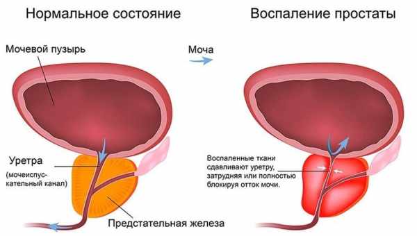 Лікування простатиту брудами