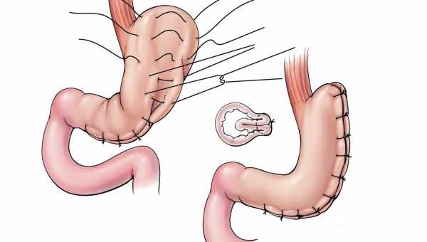 Застосування Імодіуму та інше після бандажування шлунка