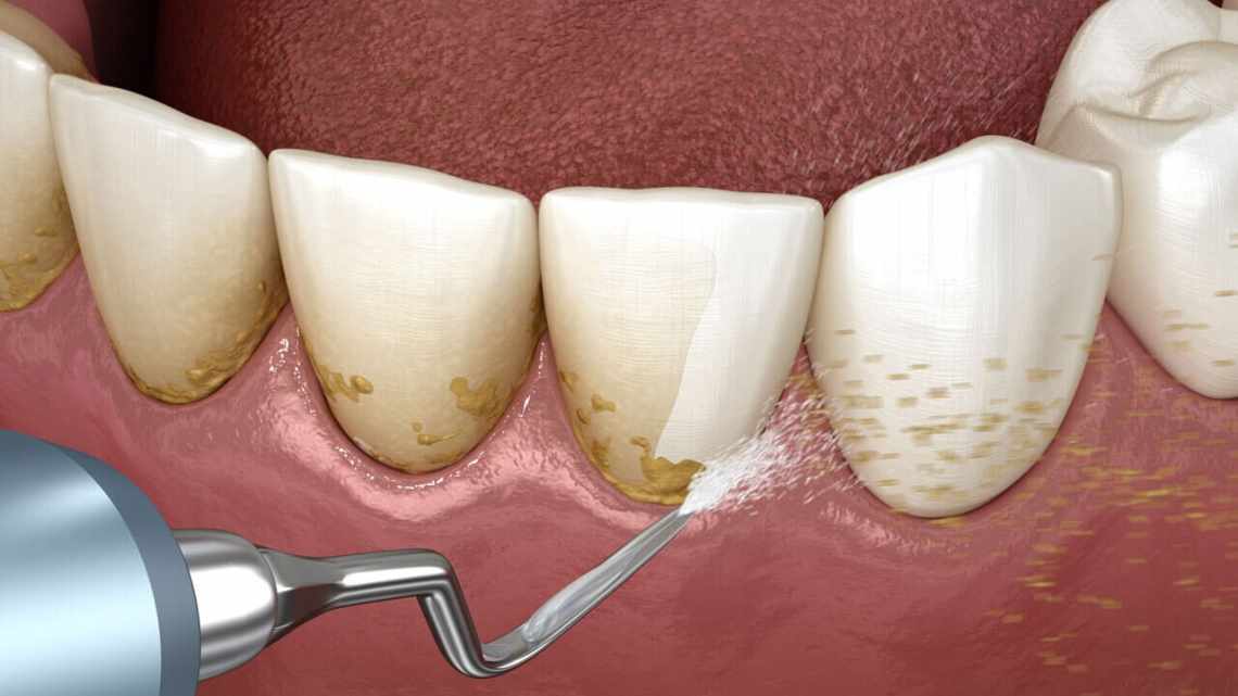Чи шкідливо знімати зубний камінь?