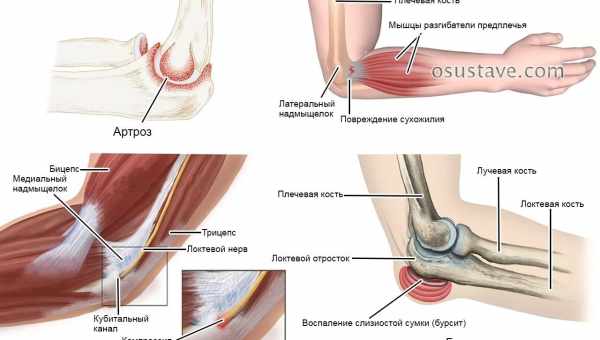 Болять суглоби ніг - що робити. З якої причини болять суглоби ніг і як правильно поставити діагноз і лікувати.