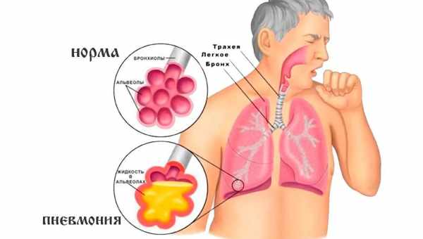 Пневмонія - причини, симптоми, діагностика, лікування