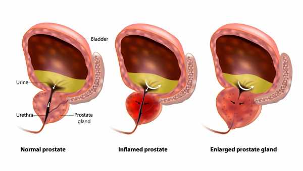 Аденома простати - причини, симптоми, діагностика, лікування