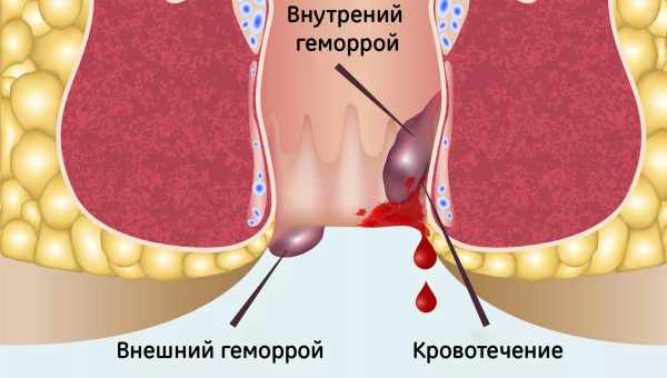 Запалення гемороїдальних вузлів: причини і симптоми. Методи лікування запалення гемороїдальних вузлів, профілактика ускладнень