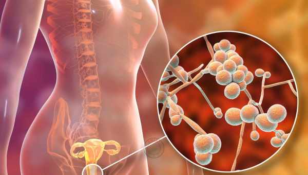 Молочниця у жінок - причини, симптоми, ускладнення і лікування. Що робити для профілактики молочниці у жінок?