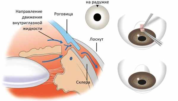 Ця підступна глаукома