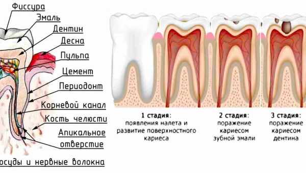 Запалення кореня зуба - причини, симптоми і лікування. Особливості перебігу запалення кореня зуба