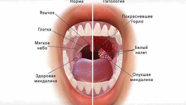 Запалення гланд: причини, симптоми. Методи лікування запалення гланд: консервативні, оперативні