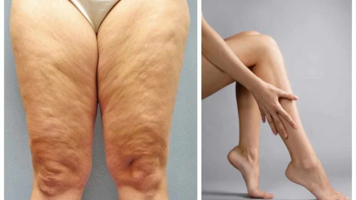 Як прибрати жир над колінами