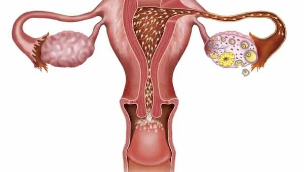 Персистуючий фолікул яєчника - що це таке