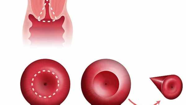 Як притискають ерозію шийки матки