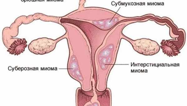 Наскільки ефективна емболізація маточних артерій при міомі матки