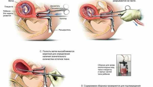 Метод обчислення індексу Соловйова при вагітності