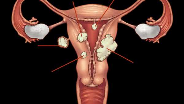 Що таке інтрамуральна лейоміома матки і як її лікувати