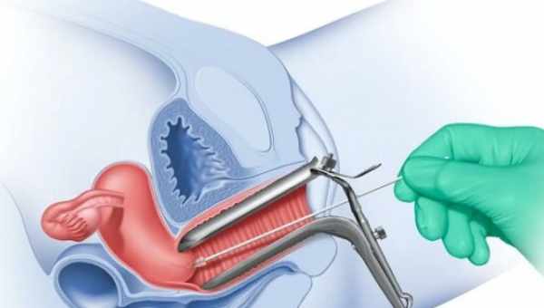 Що показує цитологія шийки матки
