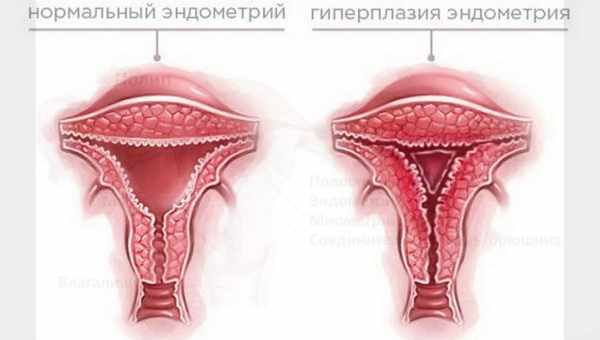 Симптоми та лікування гіперплазії ендометрія