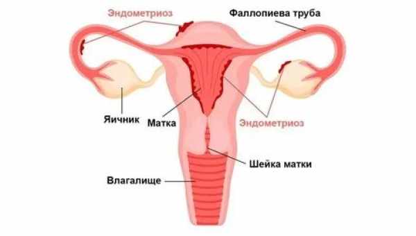 Ендометріоз матки - симптоми та лікування