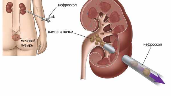 Симптоми і лікування каменів у нирках при вагітності