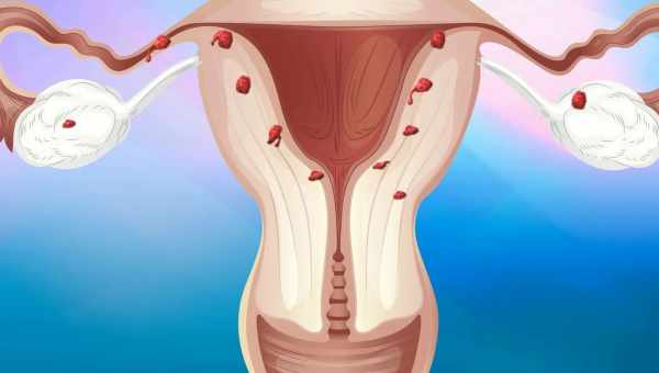 Що таке фіброму матки і як з нею боротися