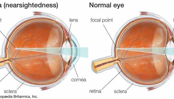 Причини виникнення та лікування короткозорості у дітей