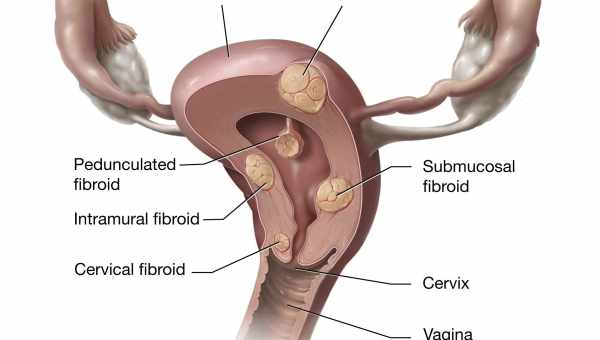 Міома матки при вагітності