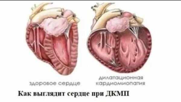 Профілактика дилатаційної кардіоміопатії