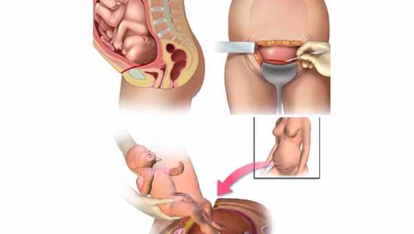 Кесаревий переріз. Як воно проходить?