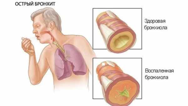 Про лікування хронічного бронхіту з використанням лазолвана